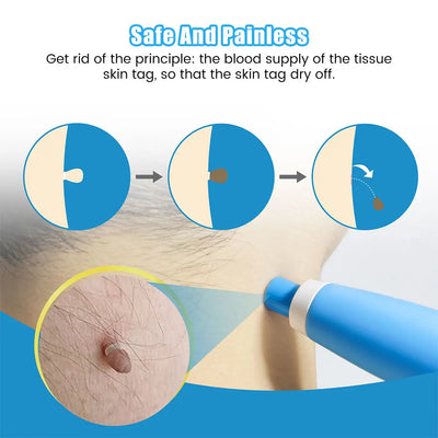 2-in-1 Auto Micro Skin Tag Remover Device